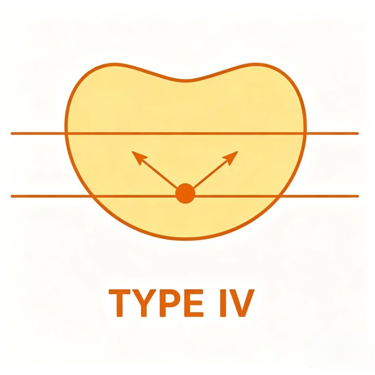 Type IV light distribution
